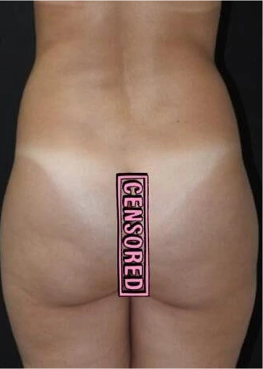 Brazilian Butt Lift before & After Banner
