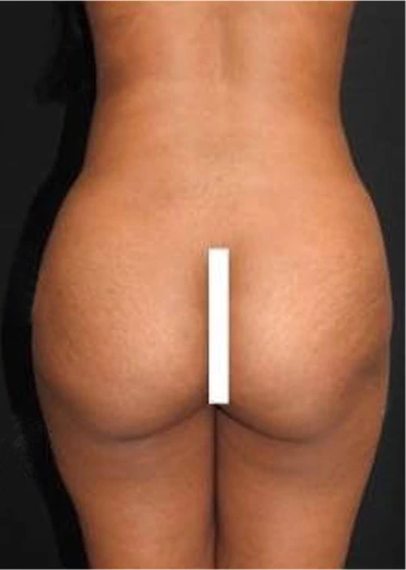 Brazilian Butt Lift before & After