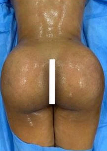 Brazilian Butt Lift before & After