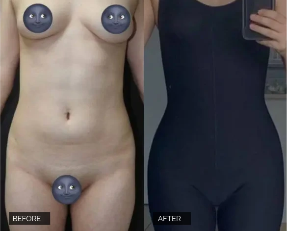 Flank Lipo Before & After