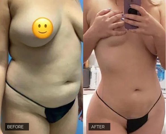 Flank Lipo Before & After Banner