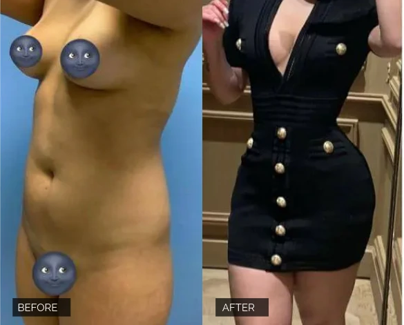 Flank Lipo Before & After Banner