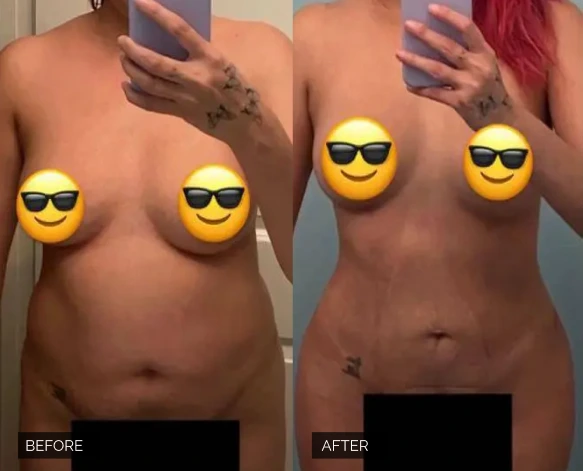 Flank Lipo Before & After Banner