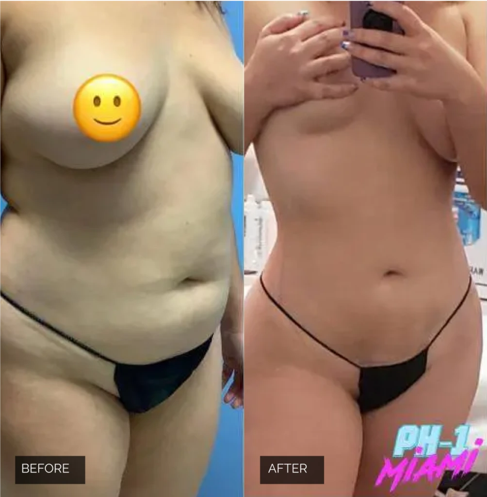 Before & After Case Liposuction banner