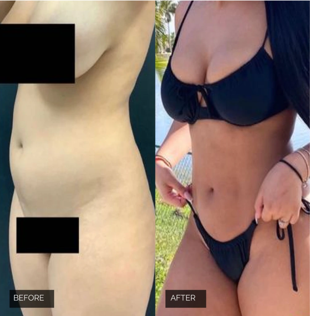 Before & After liposuction Banner